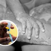 Everything you need to know about Monkeypox vaccines in Oxfordshire