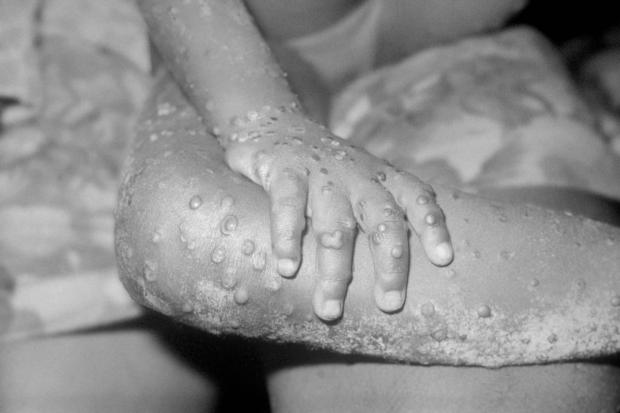 Bicester Advertiser: The monkeypox virus can be spread in a number of ways. Picture: PA